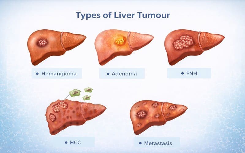 u gan lành tính có chuyển thành ác tính không