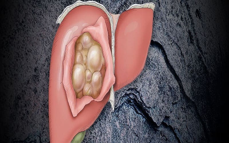 u gan lành tính có chuyển thành ác tính không