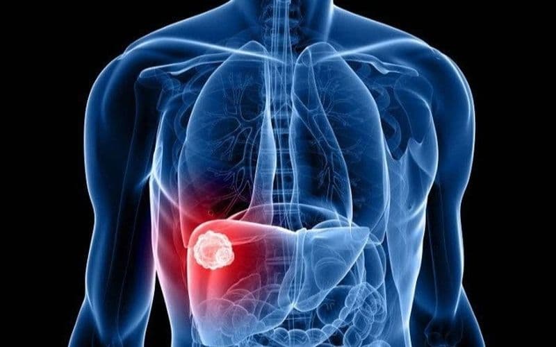 dấu hiệu u gan lành tính