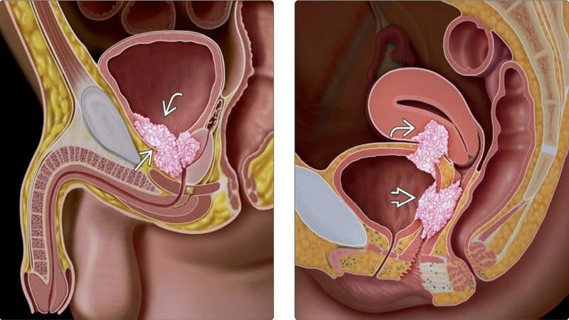 dấu hiệu u bàng quang lành tính