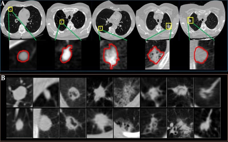 u phổi lành tính có đau không