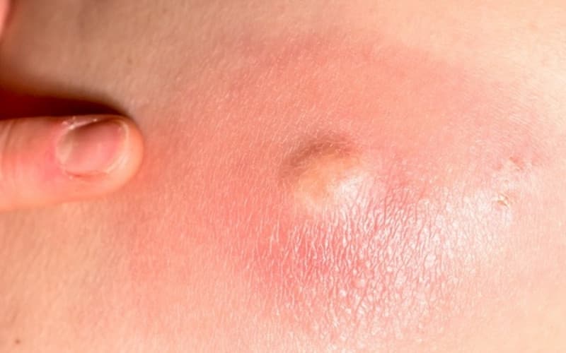 cắt u lành phần mềm đường kính dưới 10cm