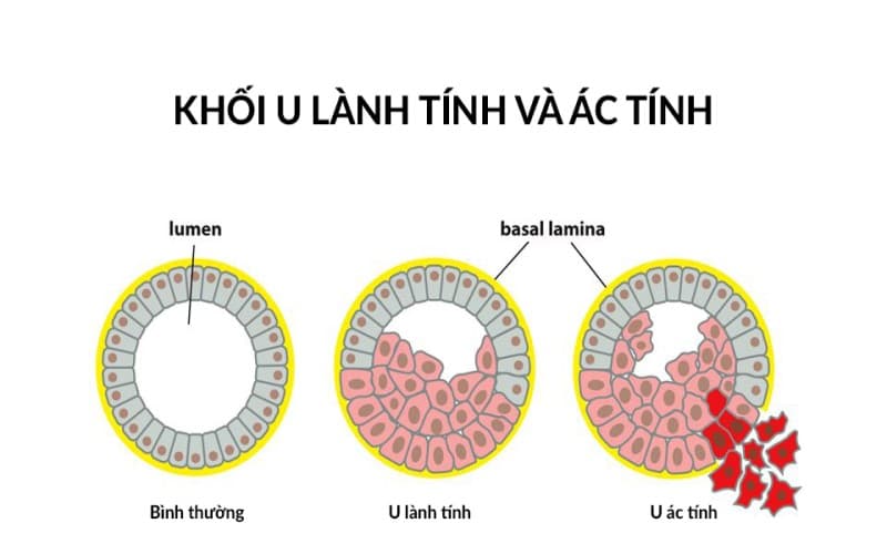 khối u lành tính có di căn không