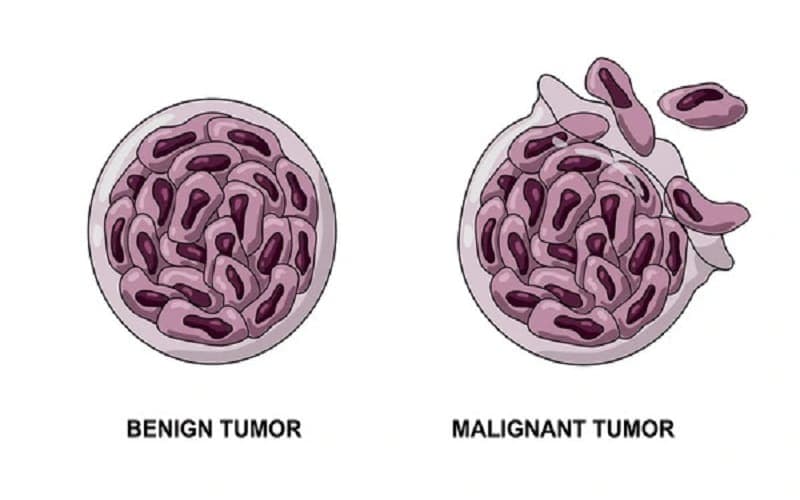 khối u lành tính có to lên không