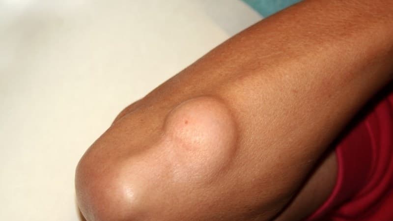 u lành tính để lâu có sao không