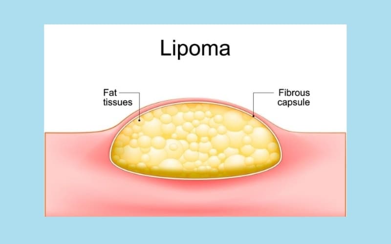 cắt u lành phần mềm đường kính trên 10cm