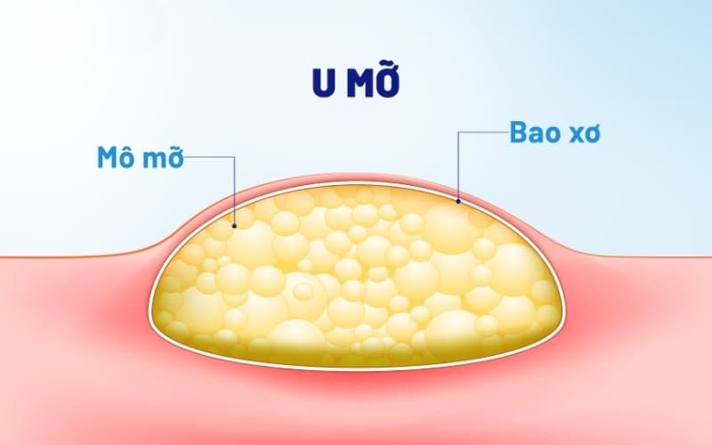 bóc u mỡ có nguy hiểm không
