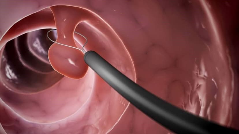 U thực quản lành tính có nguy hiểm không?