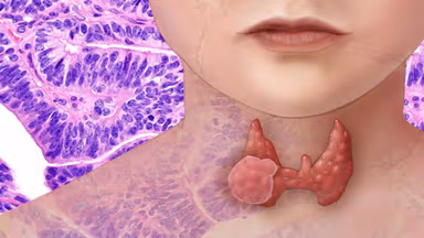 Bị u tuyến giáp có uống được thuốc tránh thai không?