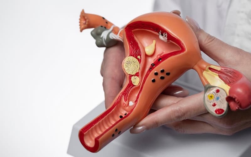 dấu hiệu u xơ tử cung lành tính