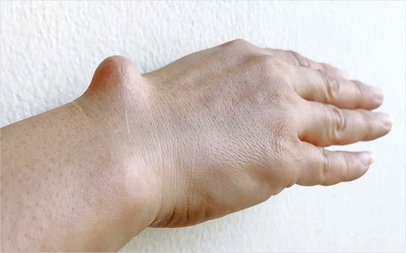 dấu hiệu u xương lành tính