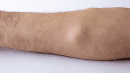 Điều trị u mỡ ở cánh tay thế nào?