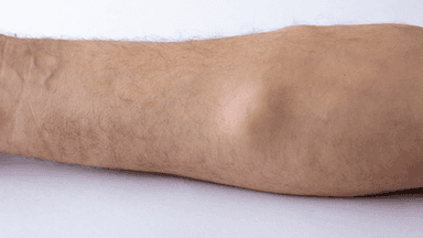 Điều trị u mỡ ở cánh tay thế nào?