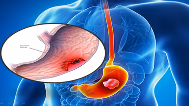 Ung thư dạ dày di căn phổi sống được bao lâu?