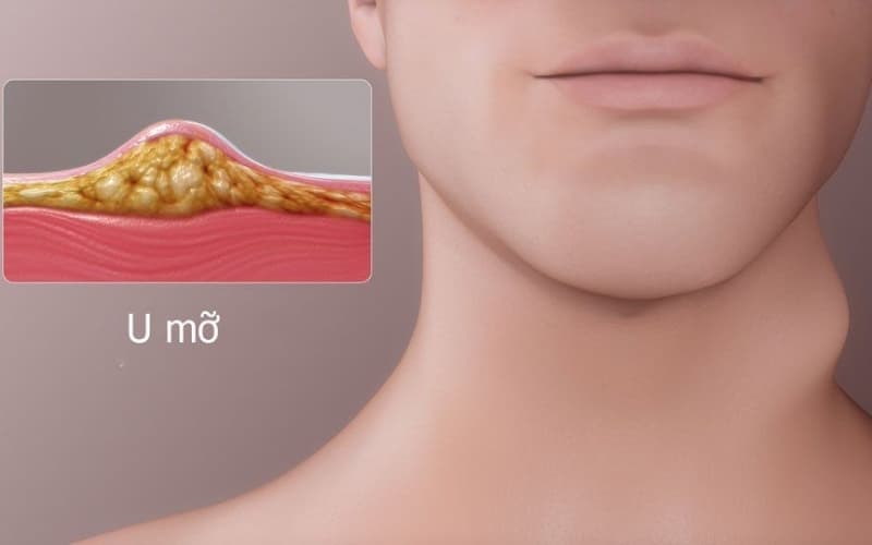 bóc u mỡ có nguy hiểm không