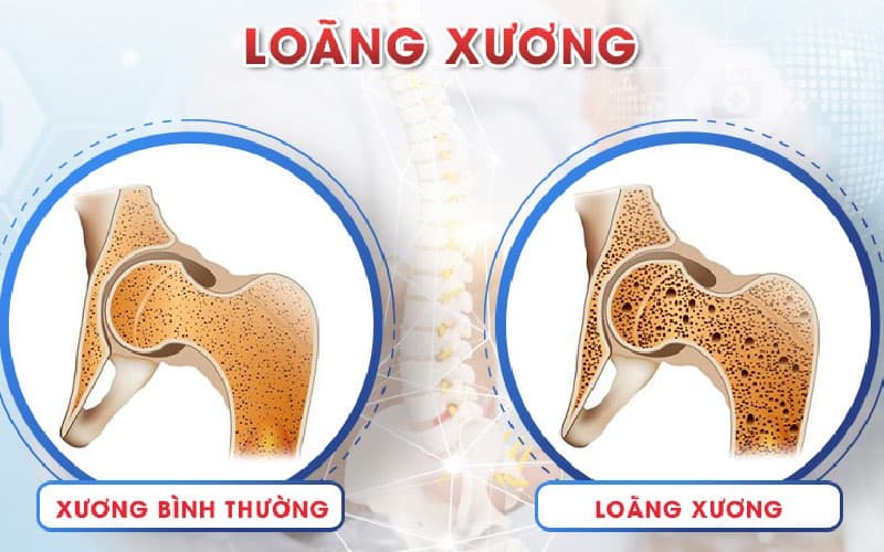 ăn mặn gây loãng xương