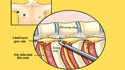 Cắt hạch giao cảm có đau không? Giải đáp chi tiết từ A đến Z