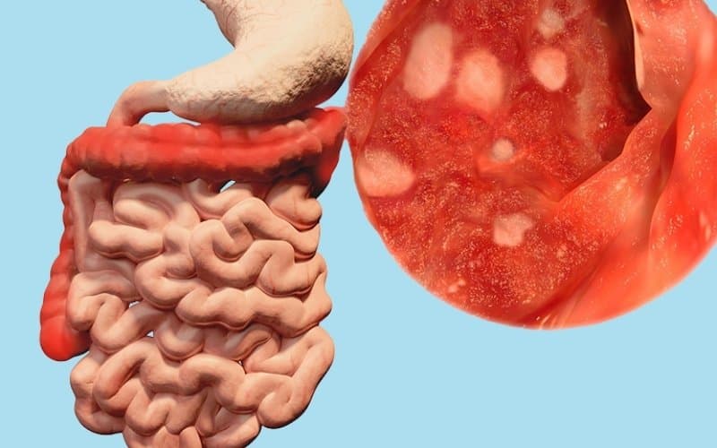 viêm đại tràng có cần nội soi không