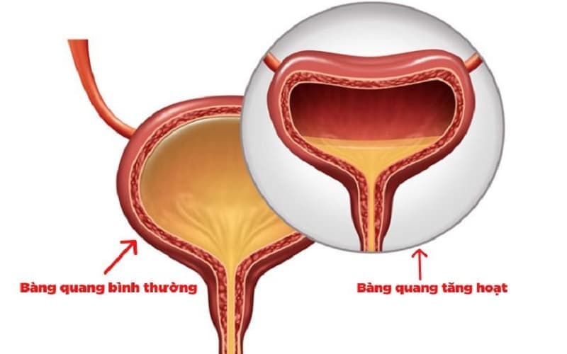 bàng quang tăng hoạt có nên nhịn tiểu
