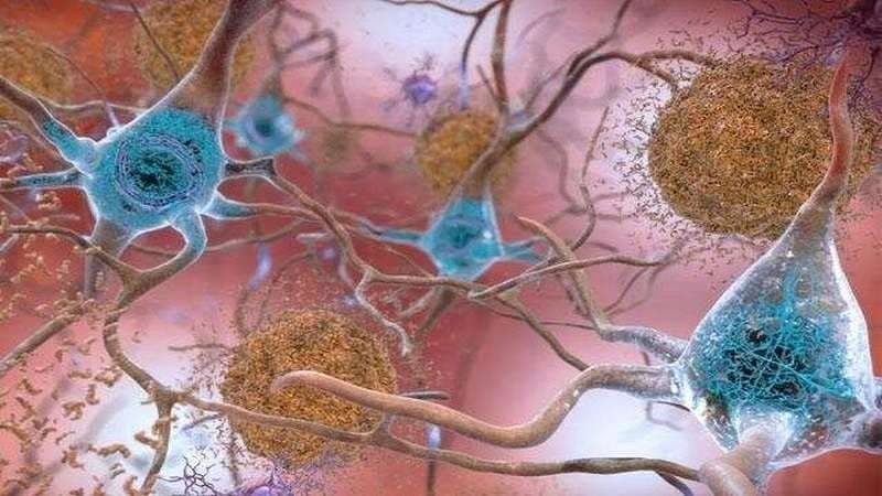 bệnh alzheimer liên quan đến rối loạn chuyển hóa