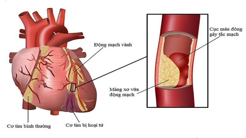 các bệnh liên quan đến rối loạn chuyển hóa lipid