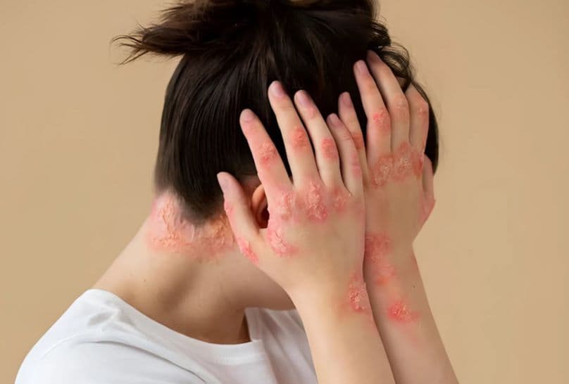 rối loạn chuyển hóa Porphyrin