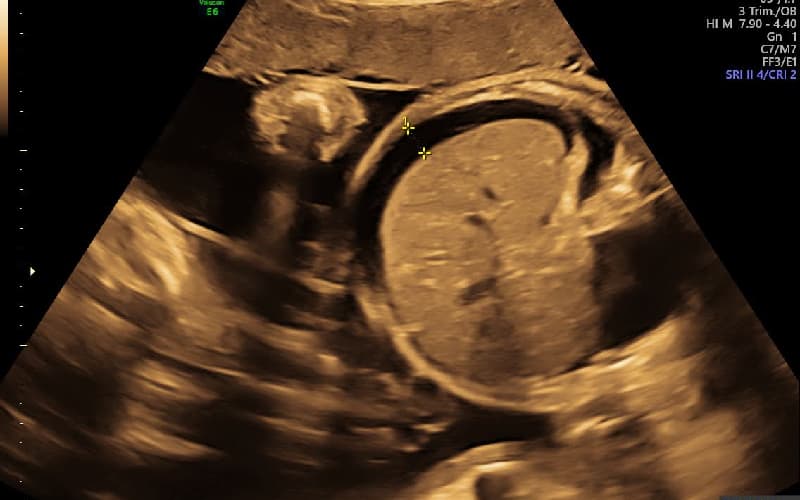 bị phù nhau thai có nguy hiểm không