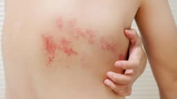 Bị zona có được rửa nước muối không?