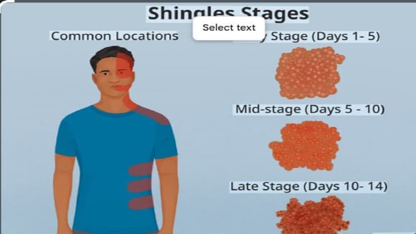 Bị zona có lây không?