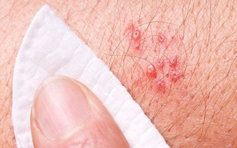 bị zona có được rửa nước muối không