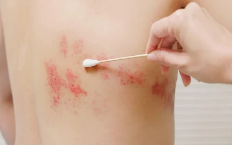 bị zona có được rửa nước muối không