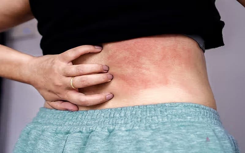 bị zona có lây không