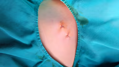 Biến chứng sau cắt hạch giao cảm: Những điều cần biết trước khi điều trị