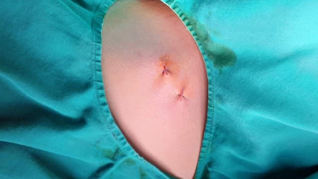 Biến chứng sau cắt hạch giao cảm: Những điều cần biết trước khi điều trị