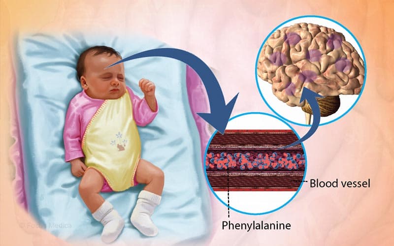 rối loạn chuyển hóa bẩm sinh là gì