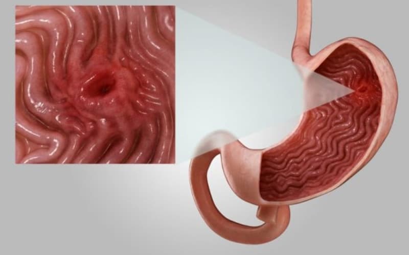 nội soi dạ dày có phát hiện ung thư không