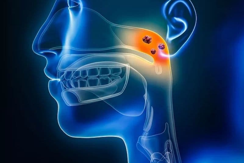 phát hiện ung thư vòm họng bằng cách nào