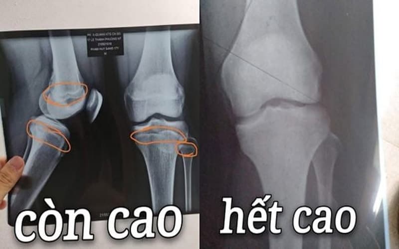 18 tuổi còn tăng chiều cao được không