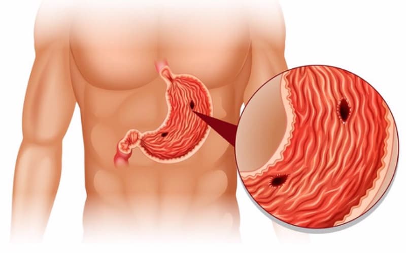 chỉ định nội soi thực quản