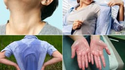 Chữa tăng tiết mồ hôi toàn thân thế nào và cách giảm tiết mồ hôi hiệu quả