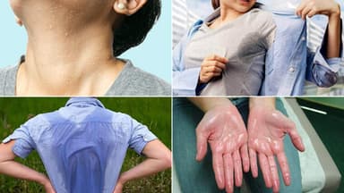 Chữa tăng tiết mồ hôi toàn thân thế nào và cách giảm tiết mồ hôi hiệu quả