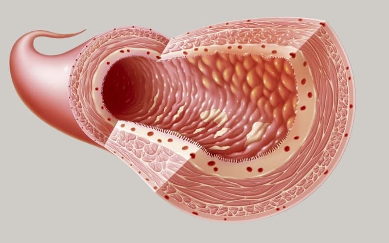 hình ảnh nội soi của bệnh crohn