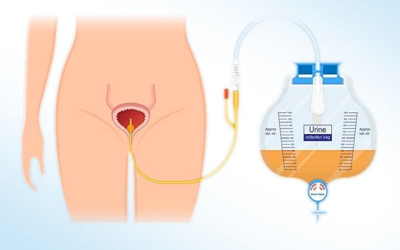 giãn bàng quang là gì