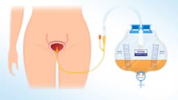 Đặt sonde bàng quang để làm gì? Khi nào cần?