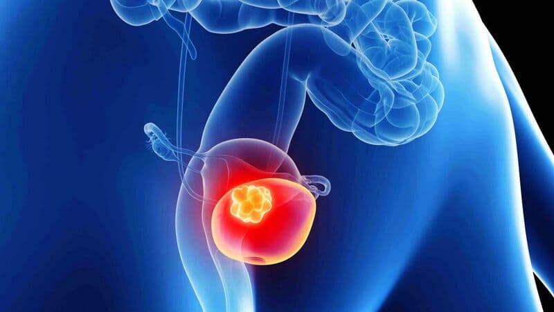 dày thành bàng quang là gì