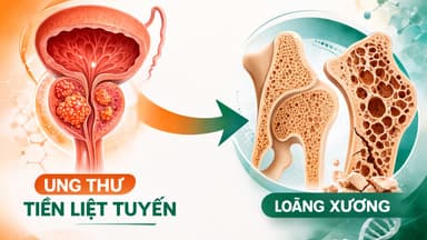 Nguy cơ loãng xương ở nam giới điều trị ung thư tiền liệt tuyến
