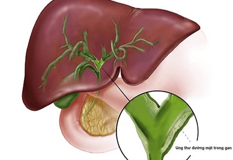ung thư đường mật trong gan có nguy hiểm không