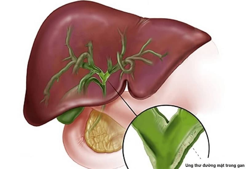 dấu hiệu ung thư đường mật