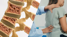 Cảnh giác lún xẹp, gãy đốt sống do loãng xương