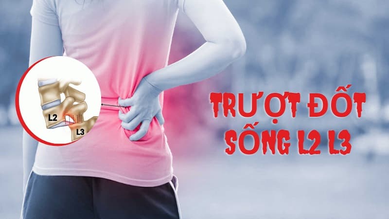 gãy đốt sống lưng L2